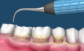 洗牙后怎么预防不长牙结石 记住这2种方法,不知道的人亏大了