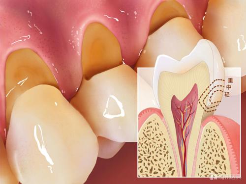 牙齿敏感 酸痛,可能是被刷出楔状缺损