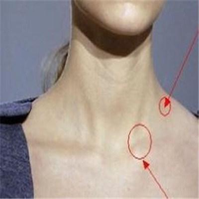 脖子淋巴癌早期图片(脖子上淋巴癌早期什么症状)