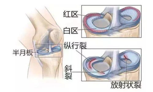 半月板撕裂图片百科 米粒分享网 Mi6fx Com