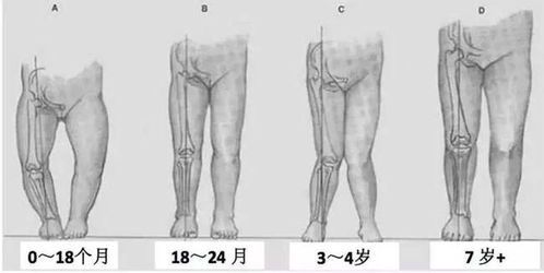 男人O型腿的人物性格特征分析(o型腿男人的命运)