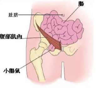 疝气长时间不治会导致什么危害(疝气长久不治会怎么样)