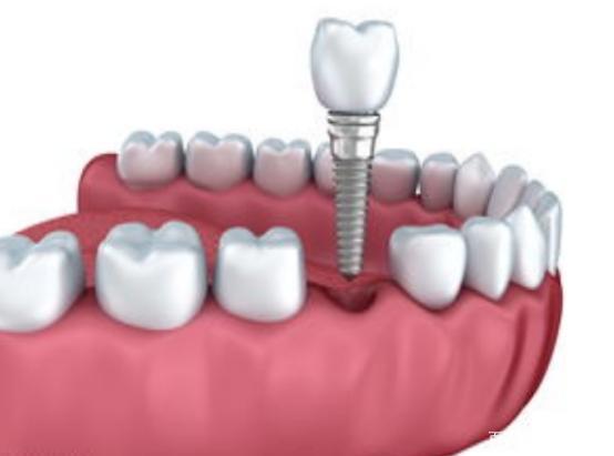2022医疗迎来大变革,种植牙将被纳入医保集采,未来一颗牙多少钱