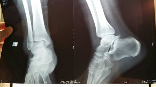 脚腓骨骨折从片子上看我现在能承重走路了吗 已经两个多月了我试着走路脚腕后脚后跟还是疼 