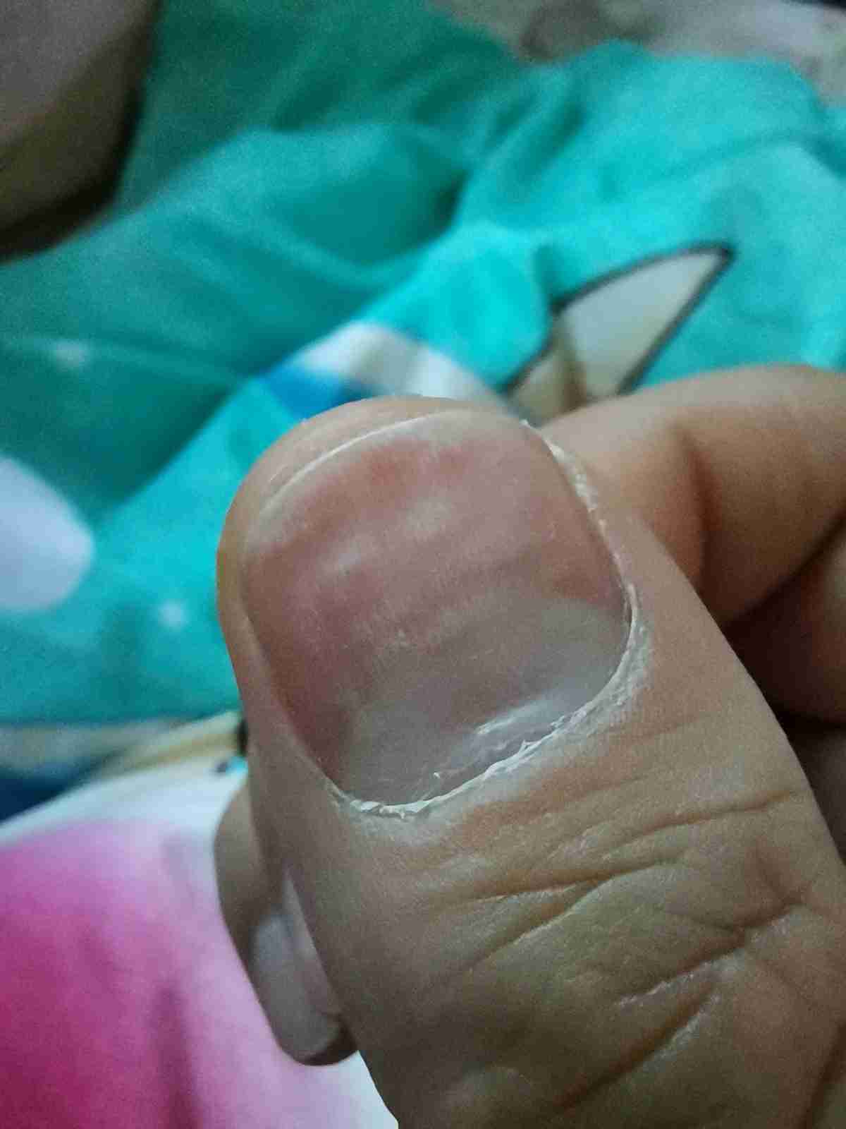 手指半月白消失了是什么原因