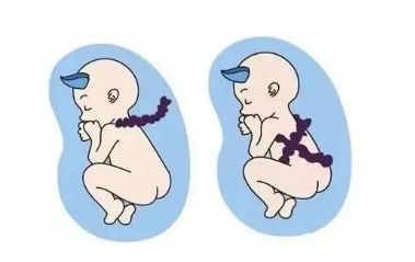 妈妈,宝宝要窒息了 发现宝宝有脐带绕颈的情况,要怎么做