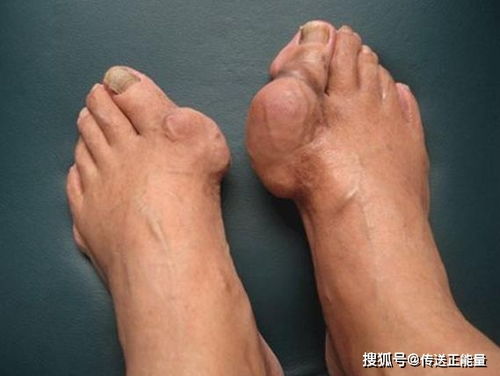 尿酸高,看 脚 知 脚部出现这4种 表现 ,建议提前预防