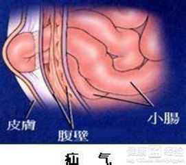 疝气手术复发率高吗