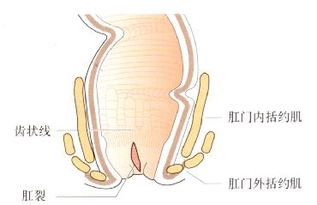 肛裂的治疗方法有哪些