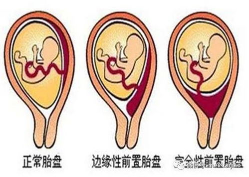 胎盘前壁 胎盘前置和胎盘后壁到底哪个好 胎盘前置到底怎么办