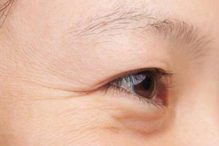 眼角纹和笑纹的区别是什么 脸上有眼角纹笑纹怎么办如何去除