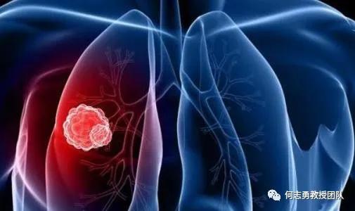 节拍化疗 优势明显的肺癌患者化疗 新选择