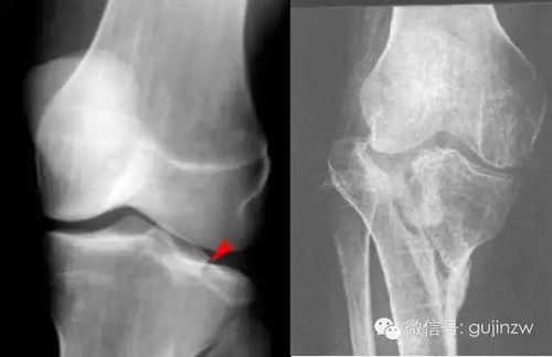 髌骨胫骨和腓骨解剖图片 信息图文欣赏 信息村 K0w0m Com