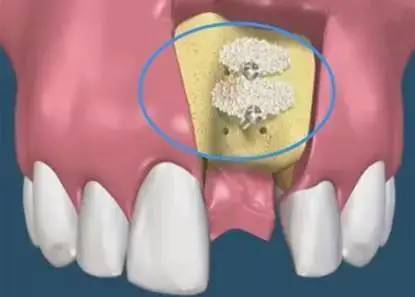骨粉是什么 种植牙为啥要我植骨