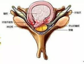 腰椎间盘突出症怎么办 阶梯治疗