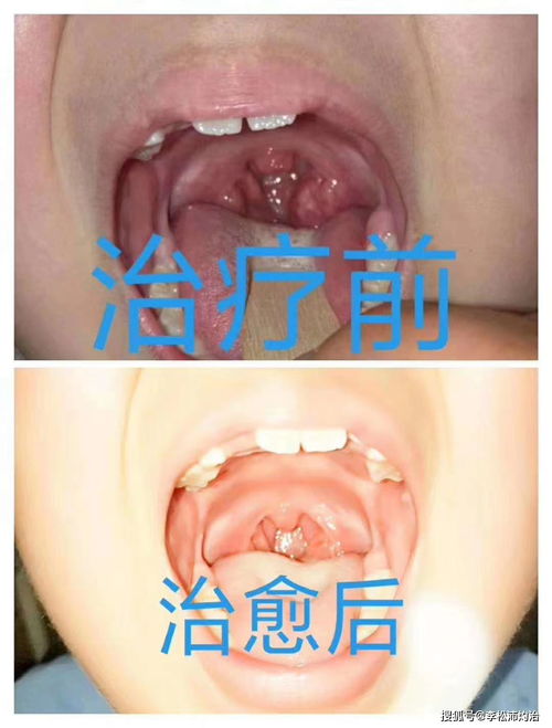 扁桃体灼烙法多少钱能做 灼烙价格贵吗