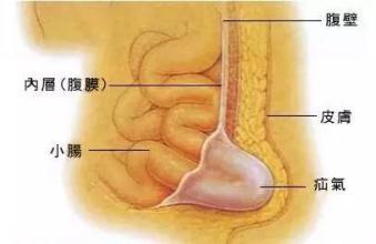 女性得了疝气应该注意什么 女性必看 