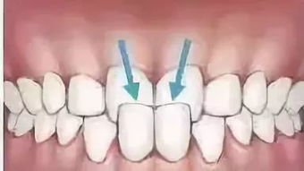 牙齿需尽早矫正的 9大信号