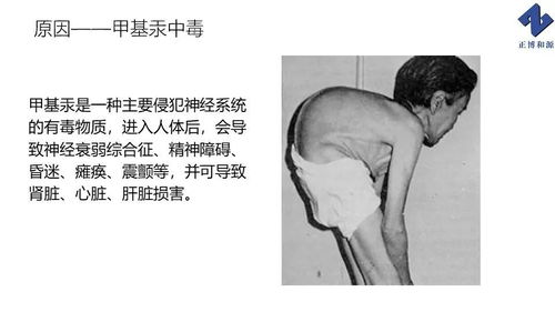 食品安全案例辨析 1956年日本水俣病事件 汞中毒