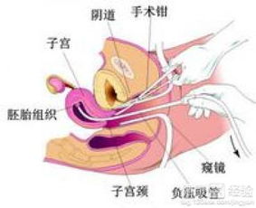 无痛人流后b超宫腔没有残留物子宫内膜不均匀怎么办