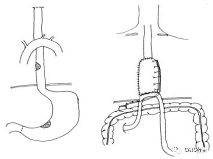 保留胃网膜右血管弓胃代食管术治疗同期食管 胃双原发癌