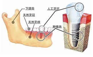 大连齿医生口腔科普 掌握种植牙准确的时间 术后五点事项莫忽视