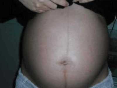 原创为什么怀孕后肚子会出现一条黑线肚子上的黑线什么时候出现