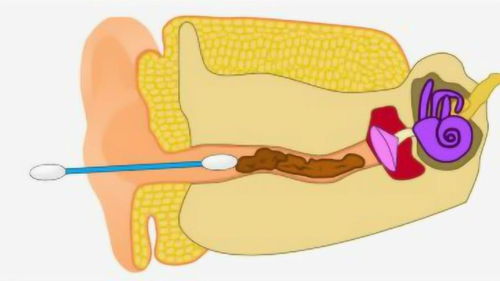 3D动画演示掏耳朵,看完你就明白,为什么医生不建议用棉签掏耳朵 