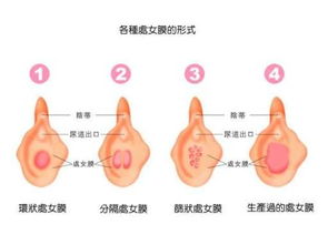 健康女性处女膜变化过程 图 2