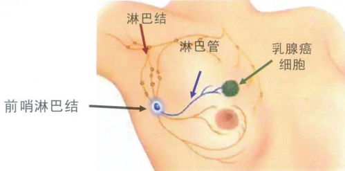 一时疏于体检,她的乳腺也悄悄长出肿块