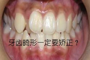 长乐畸形牙是否一定要矫正,牙齿不齐有危害吗