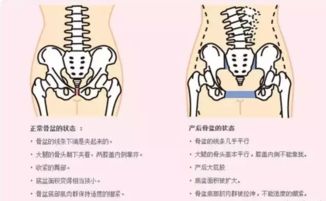 产后修复盆底肌恢复训练 