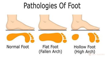 我发现自家孩子脚好像有点扁平足但是又不太确定，有什么办法检测自家孩子的脚？