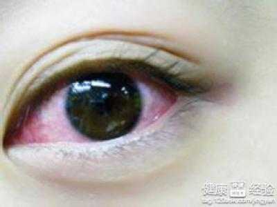 红眼病有什么症状