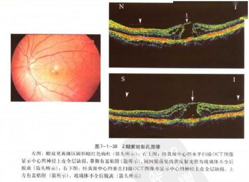 眼底病黄斑裂孔