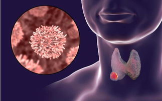治疗甲状腺囊肿 短平快 的方法有哪些 谨记4点,让治疗变得更简单