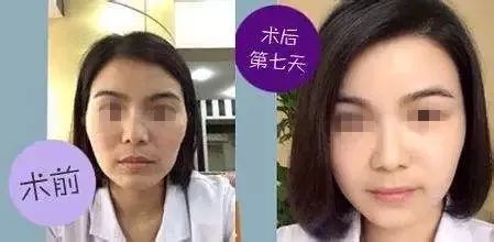 这里凹陷,是不吉面相 