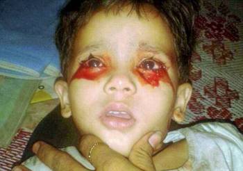 印度一3岁女童疑患罕见 血汗症 眼耳口每日出血