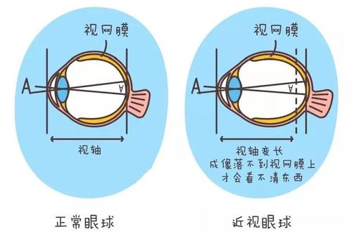 近视不仅是戴副眼镜那么简单 还有这些危害