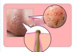 你还在为粉刺黑头傻傻分不清楚而烦恼吗
