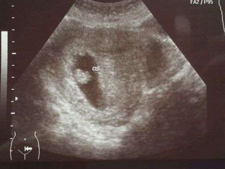 怀孕六周未见胎芽及胎心搏动