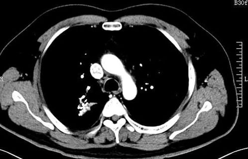 肺腺癌靶向治疗后T790M突变1例