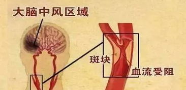 疗效才是硬道理8 手术中突发脑梗,用中医药治好