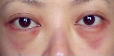 外切去眼袋多久恢复正常 外切去眼袋会留疤吗 看看和你知道的一样不