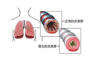 急性之气管炎吃什么好