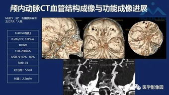 静脉血管红外成像技术