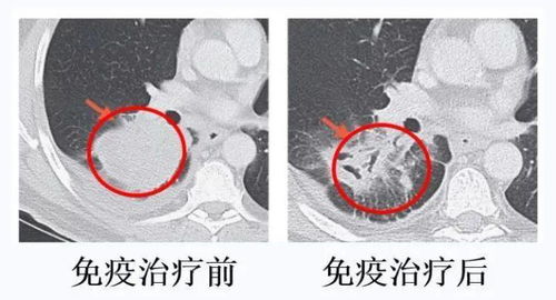 让肺癌 降期 ,重获手术机会,新辅助免疫是怎么做到的