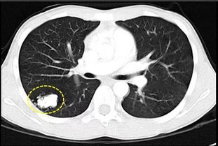 你是肺癌高危人群吗,查出肺部磨玻璃病变怎么办