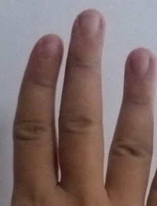 我的十根手指都是歪的不直的,是遗传我爸 我因为手指长得歪不直心里自卑痛苦 我的手指是畸形和残疾吗 