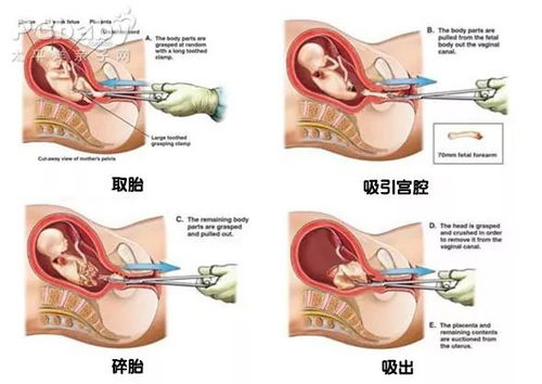 女性打过胎,会留下什么痕迹吗 